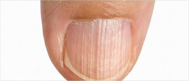 Images of nail ridges